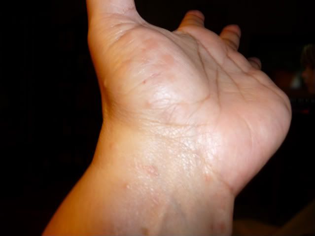 Red Itchy Rash On Hands